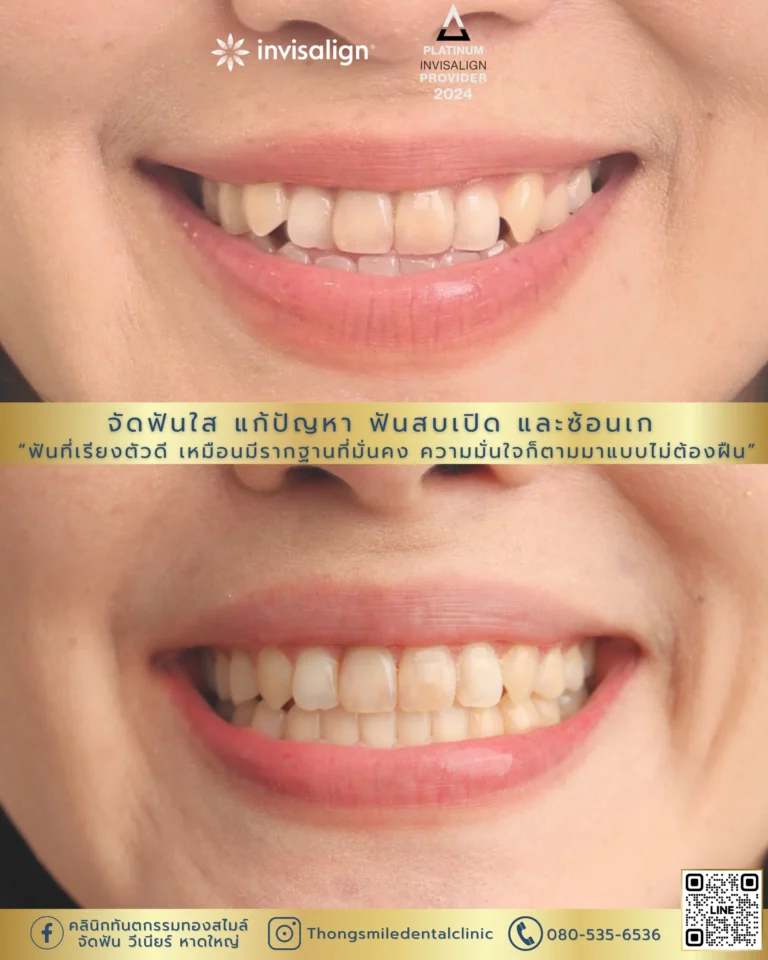 20260429 Before and After review of Thong Smile Orthodontic Treatment 14