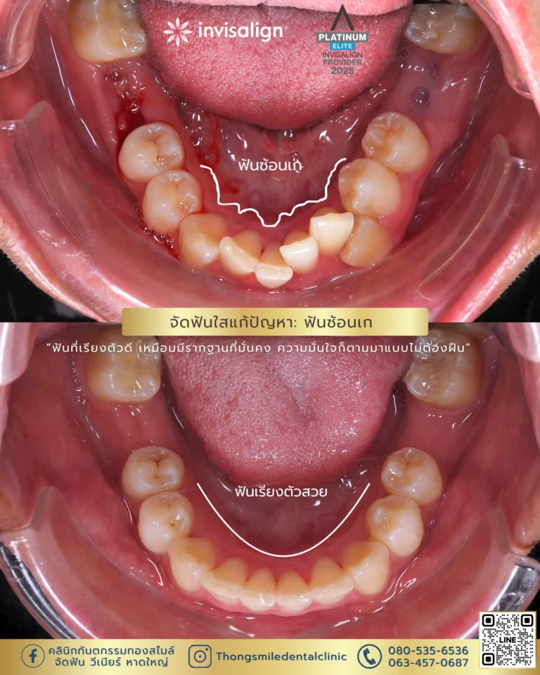 20260429 Before and After review of Thong Smile Orthodontic Treatment 21