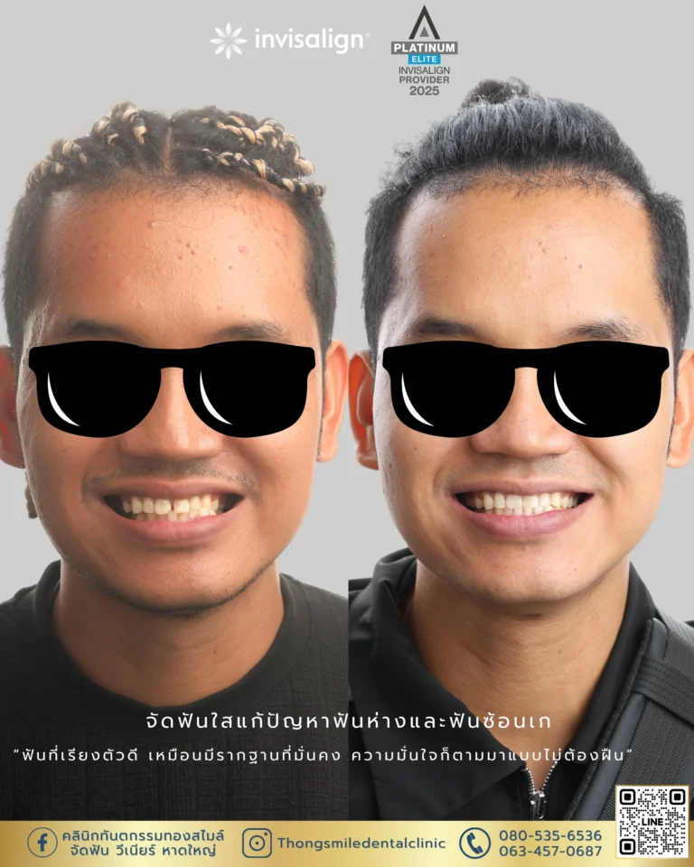 20260429 Before and After review of Thong Smile Orthodontic Treatment 27