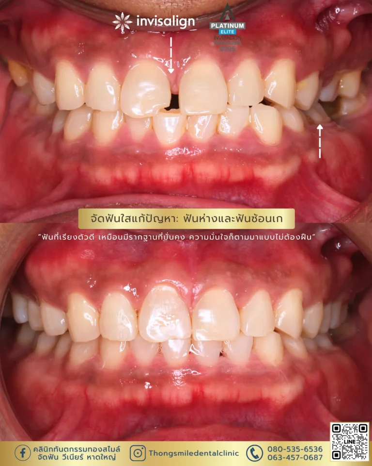 20260429 Before and After review of Thong Smile Orthodontic Treatment 28