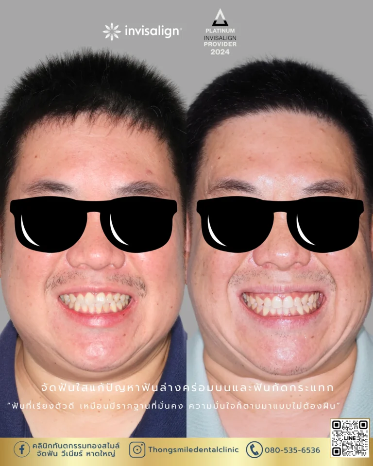 20260429 Before and After review of Thong Smile Orthodontic Treatment 32
