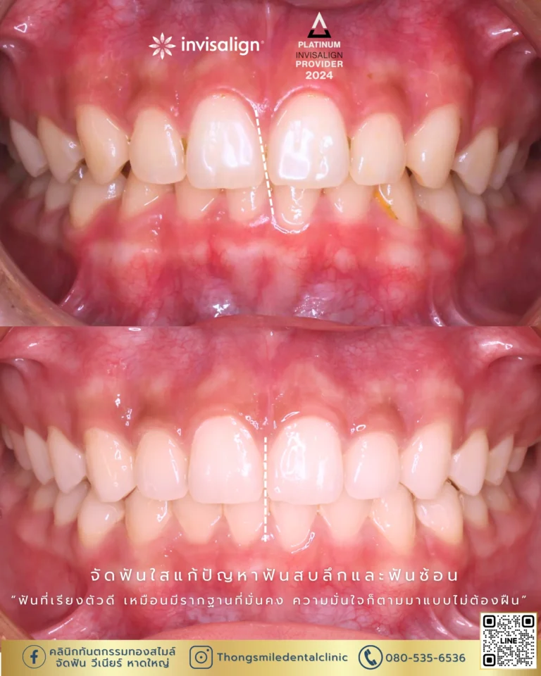 20260429 Before and After review of Thong Smile Orthodontic Treatment 33