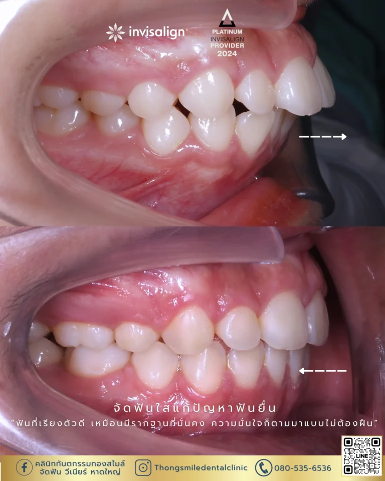 20260429 Before and After review of Thong Smile Orthodontic Treatment 38