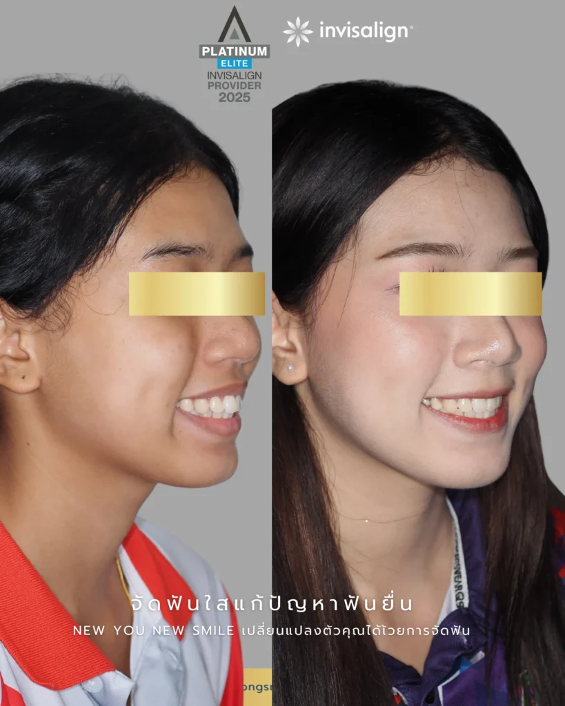 จัดฟันแบบไหนดี? เปรียบเทียบแต่ละแบบเลือกให้เหมาะกับคุณ