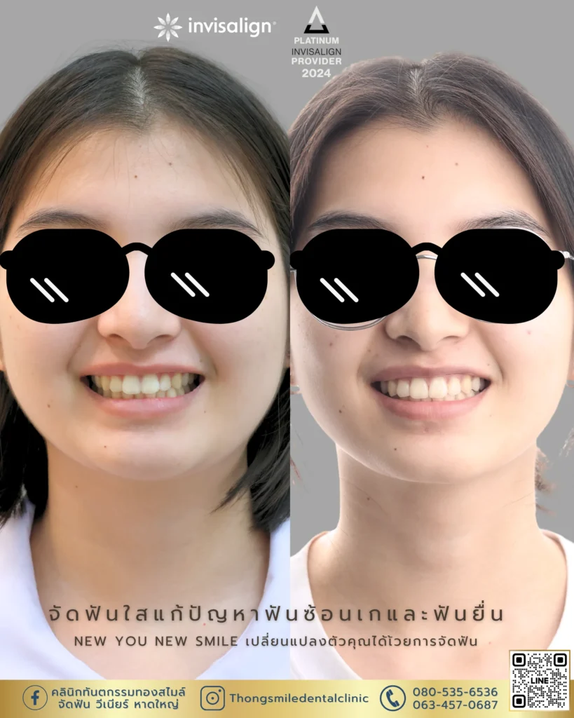 จัดฟันแบบไหนดี? เปรียบเทียบแต่ละแบบเลือกให้เหมาะกับคุณ