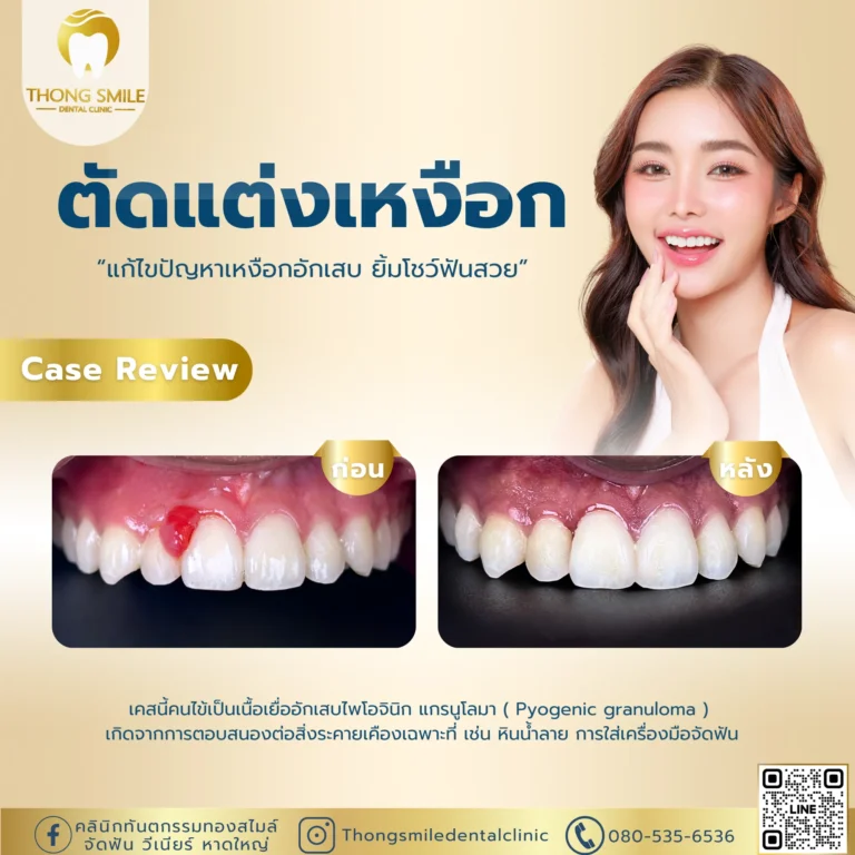 20260429 Gum reshaping correcting gingivitis for a beautiful smile