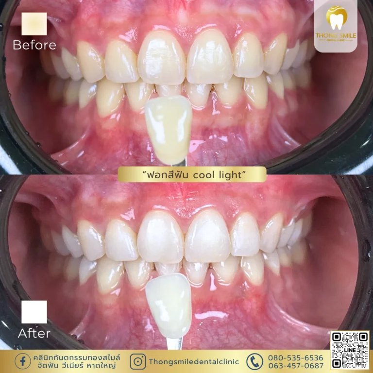 20260429 Review of teeth whitening to transform yellow teeth into white teeth1