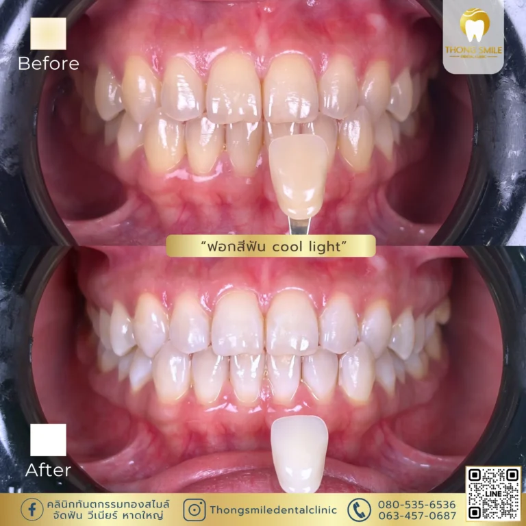 20260429 Review of teeth whitening to transform yellow teeth into white teeth2