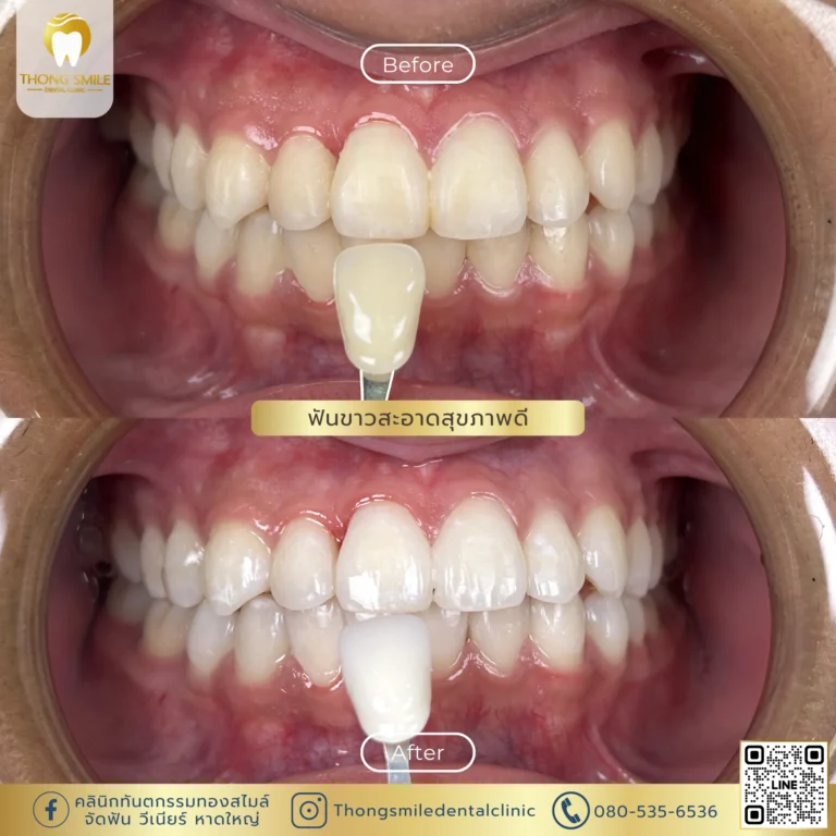 20260429 Review of teeth whitening to transform yellow teeth into white teeth3
