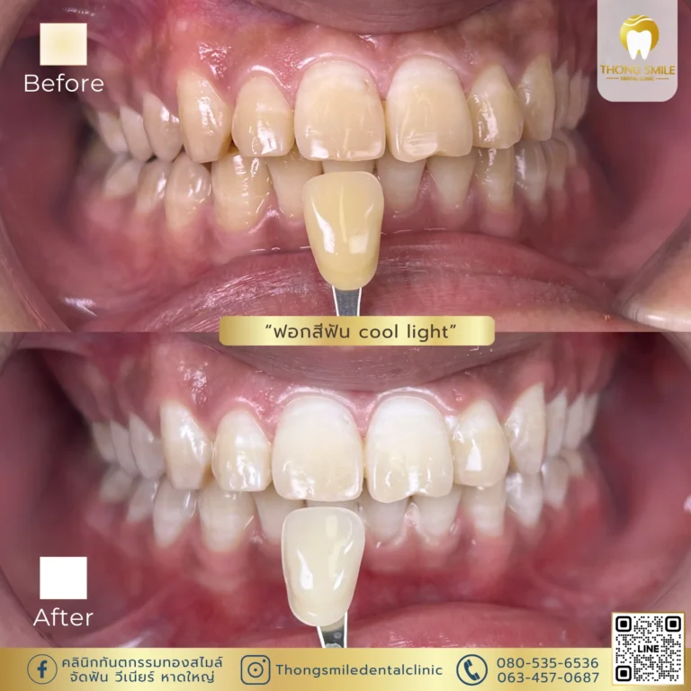 20260429 Review of teeth whitening to transform yellow teeth into white teeth4