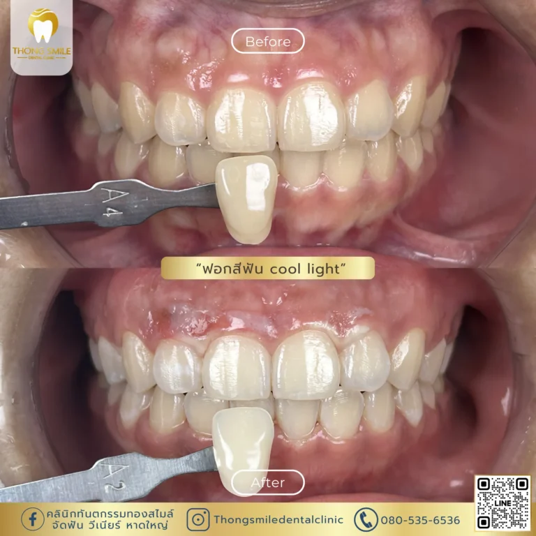 20260429 Review of teeth whitening to transform yellow teeth into white teeth5