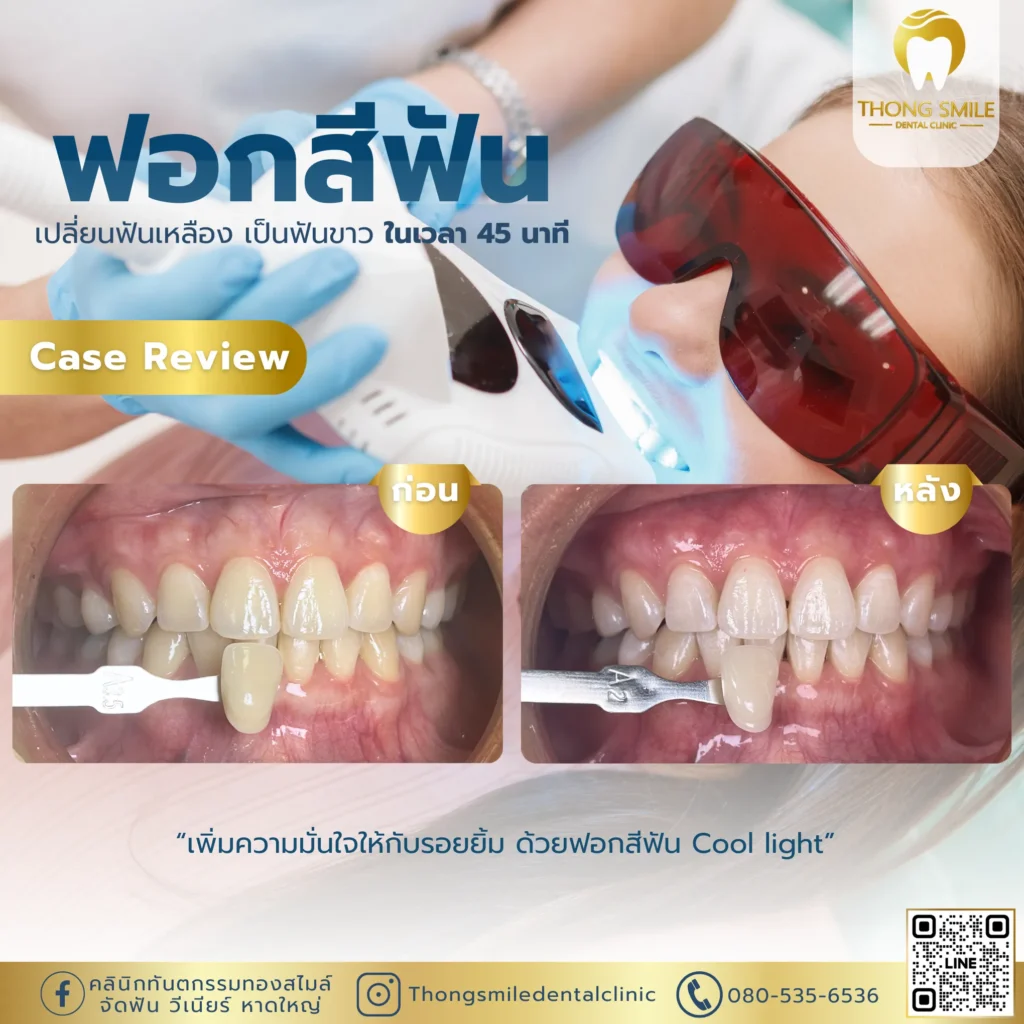 ฟอกสีฟันอันตรายไหม? ข้อควรรู้ก่อนตัดสินใจ