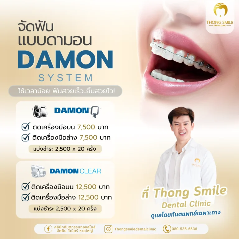 20260429 จัดฟันแบบดามอน DAMON SYSTEM ใช้เวลาน้อย ฟันสวยเร็ว ยิ้มสวยไว