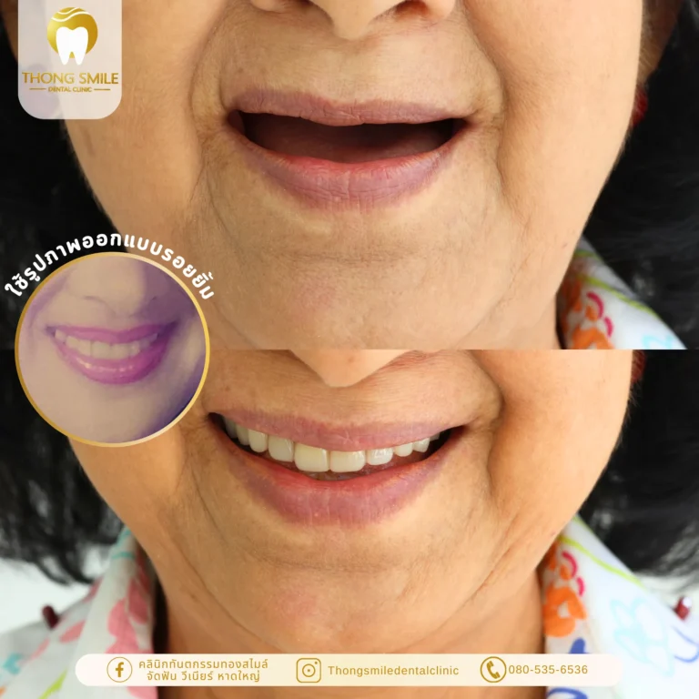 Before and after review of dentures