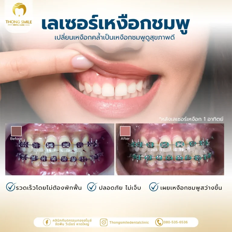 Before and after review of gum laser treatment