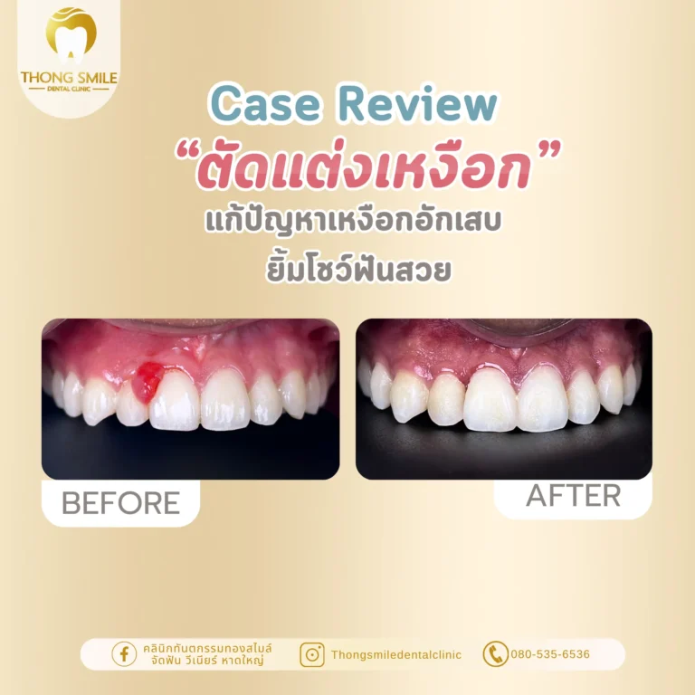 Before and after review of gum reshaping 38