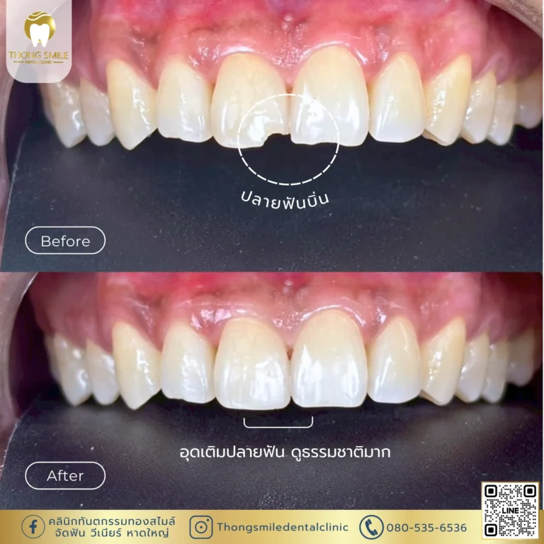 Before and after review of veneer procedure 1