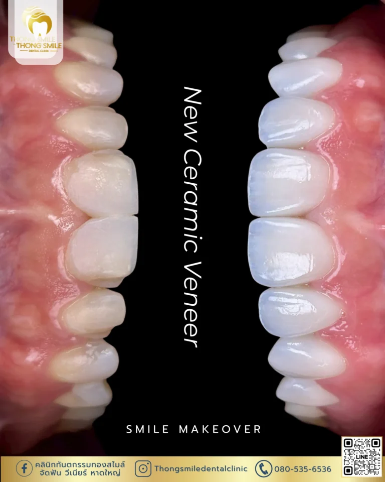Before and after review of veneer procedure 38
