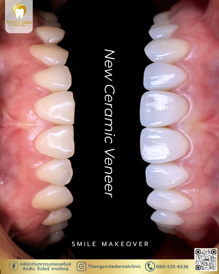 Before and after review of veneer procedure 39