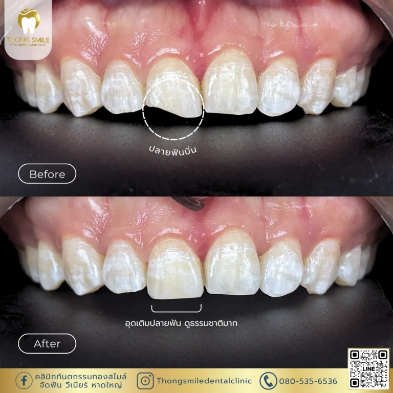 Before and after review of veneer procedure 4