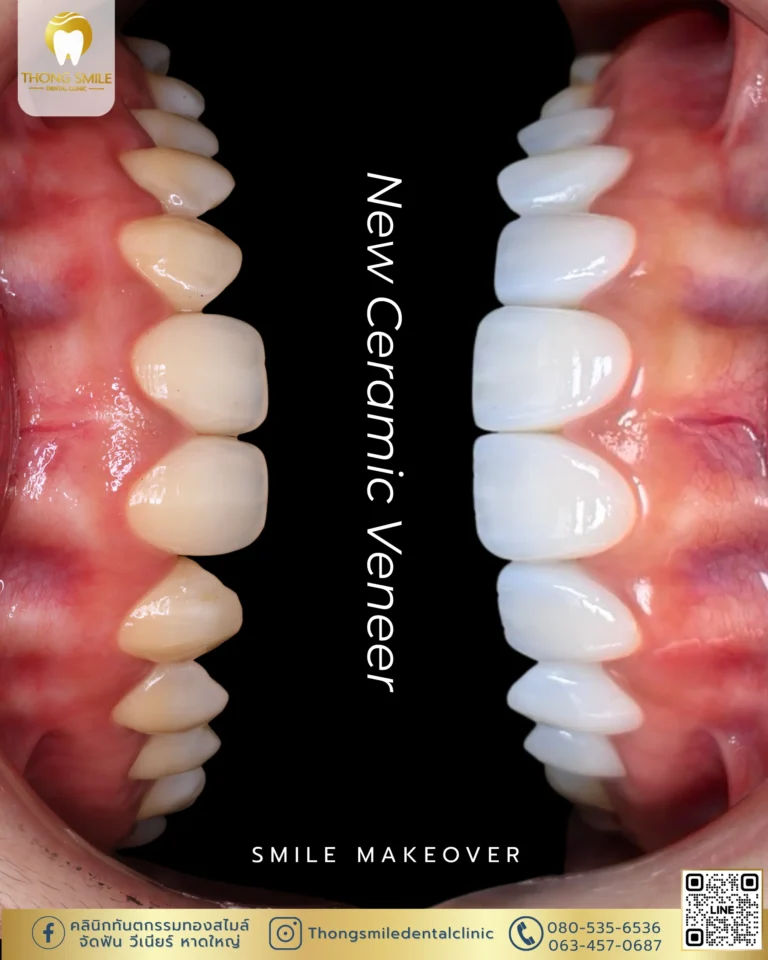 Before and after review of veneer procedure 40