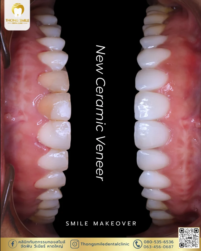Before and after review of veneer procedure 41