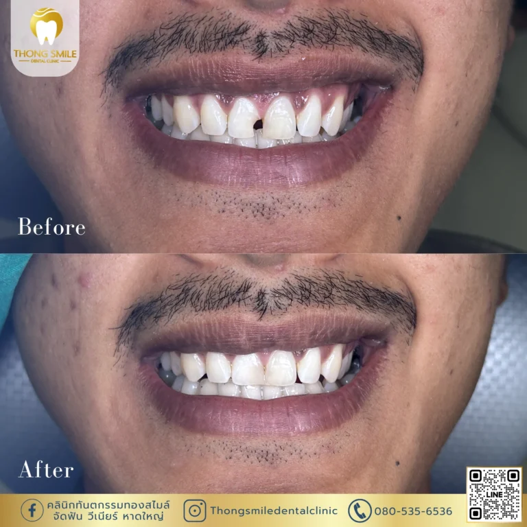 Before and after review of veneer procedure Before and after review of veneer procedure 3