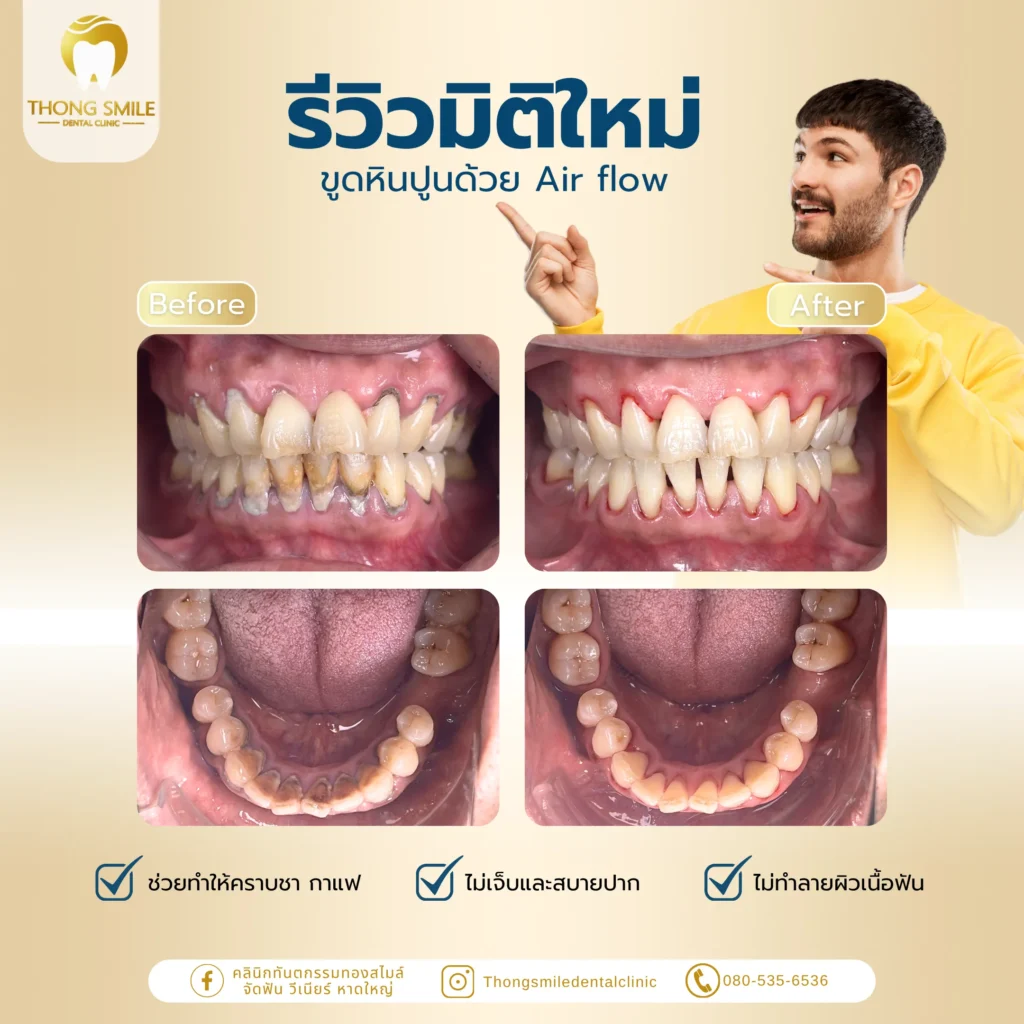 ขูดหินปูนจำเป็นไหม? เคลียร์ทุกคำถามเกี่ยวกับการขูดหินปูนเพื่อสุขภาพฟัน