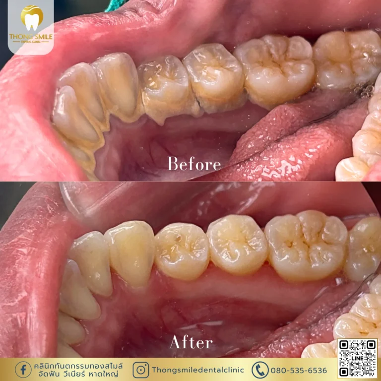 Review of teeth scaling 20