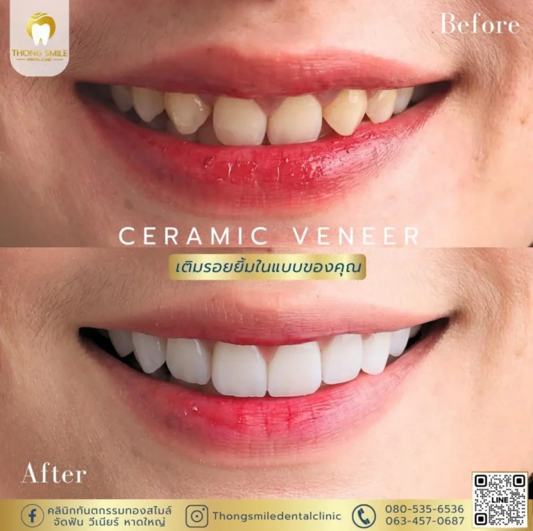 20260508 Case Thong Smile _1_260508_12 (Horizontal)