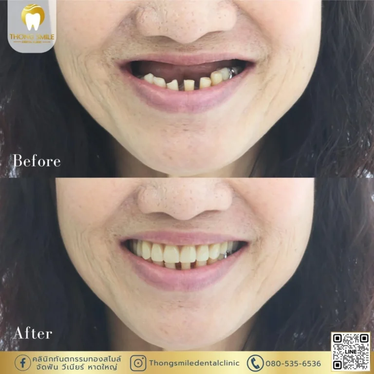 20260508 Case Thong Smile _1_260508_30 (Horizontal)
