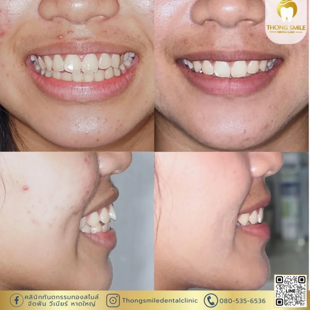 จัดฟันแบบไหนดี? เปรียบเทียบแต่ละแบบเลือกให้เหมาะกับคุณ 2 20260508 Case Thong Smile 1 260508 63 Horizontal