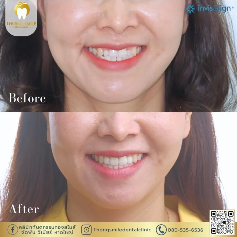 20260508 Case Thong Smile _1_260508_67 (Horizontal)