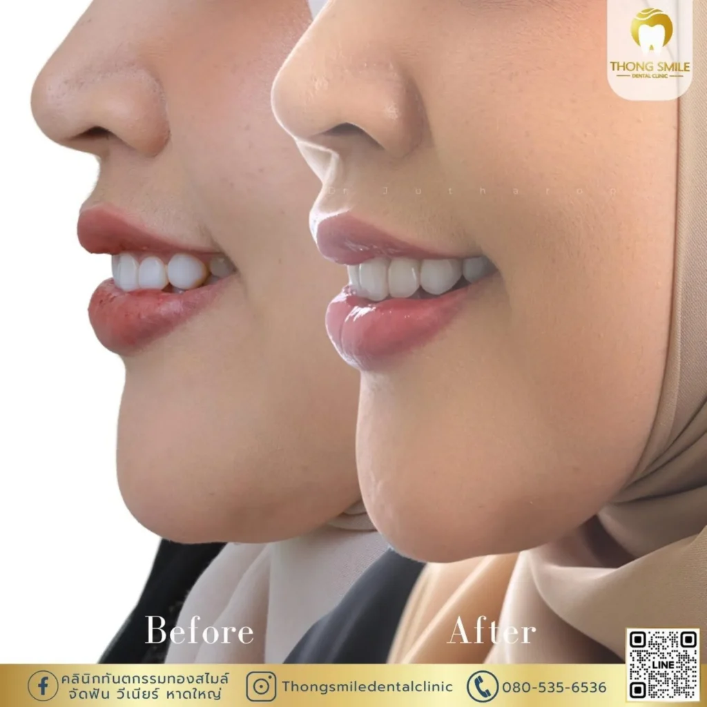 วีเนียร์คืออะไร? ทำไมถึงช่วยเปลี่ยนรอยยิ้มให้สวยงามทันที! 3 20260508 Case Thong Smile 1 260508 68 Horizontal
