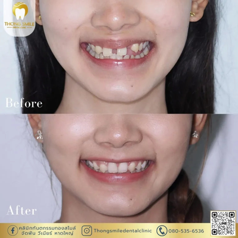 20260508 Case Thong Smile _1_260508_71 (Horizontal)