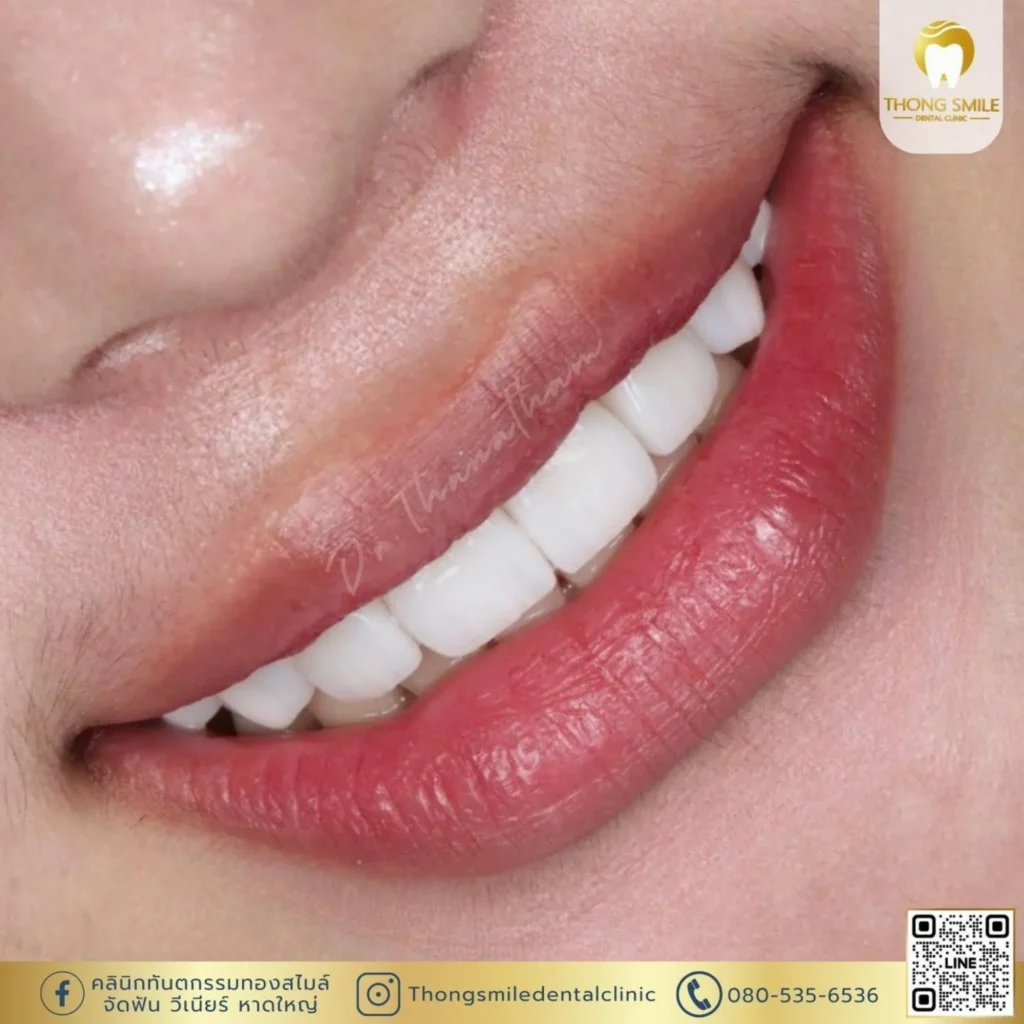 20260508 Case Thong Smile 1 260508 82 Horizontal