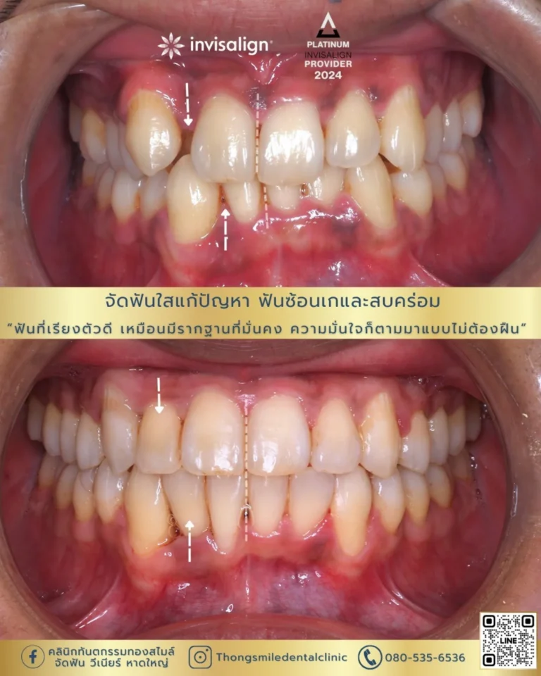 20260508 Case Thong Smile _2_260508_17 (Horizontal)