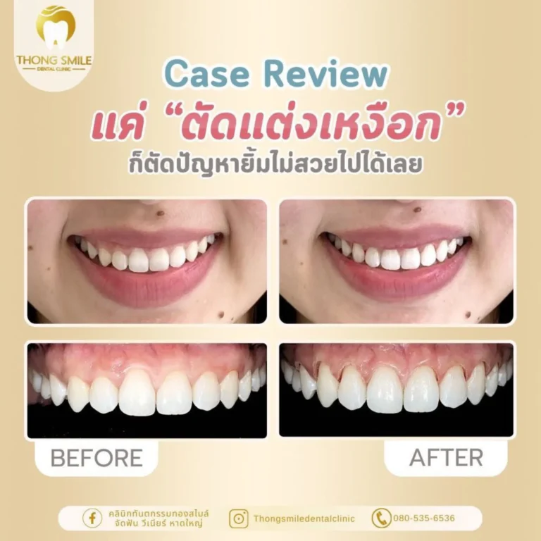 20260508 Case Thong Smile _2_260508_25 (Horizontal)