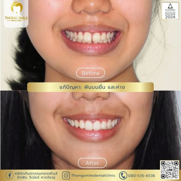20260508 Case Thong Smile_260508_13 (Horizontal)