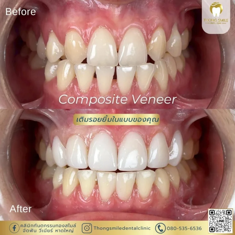 20260508 Case Thong Smile_260508_14 (Horizontal)