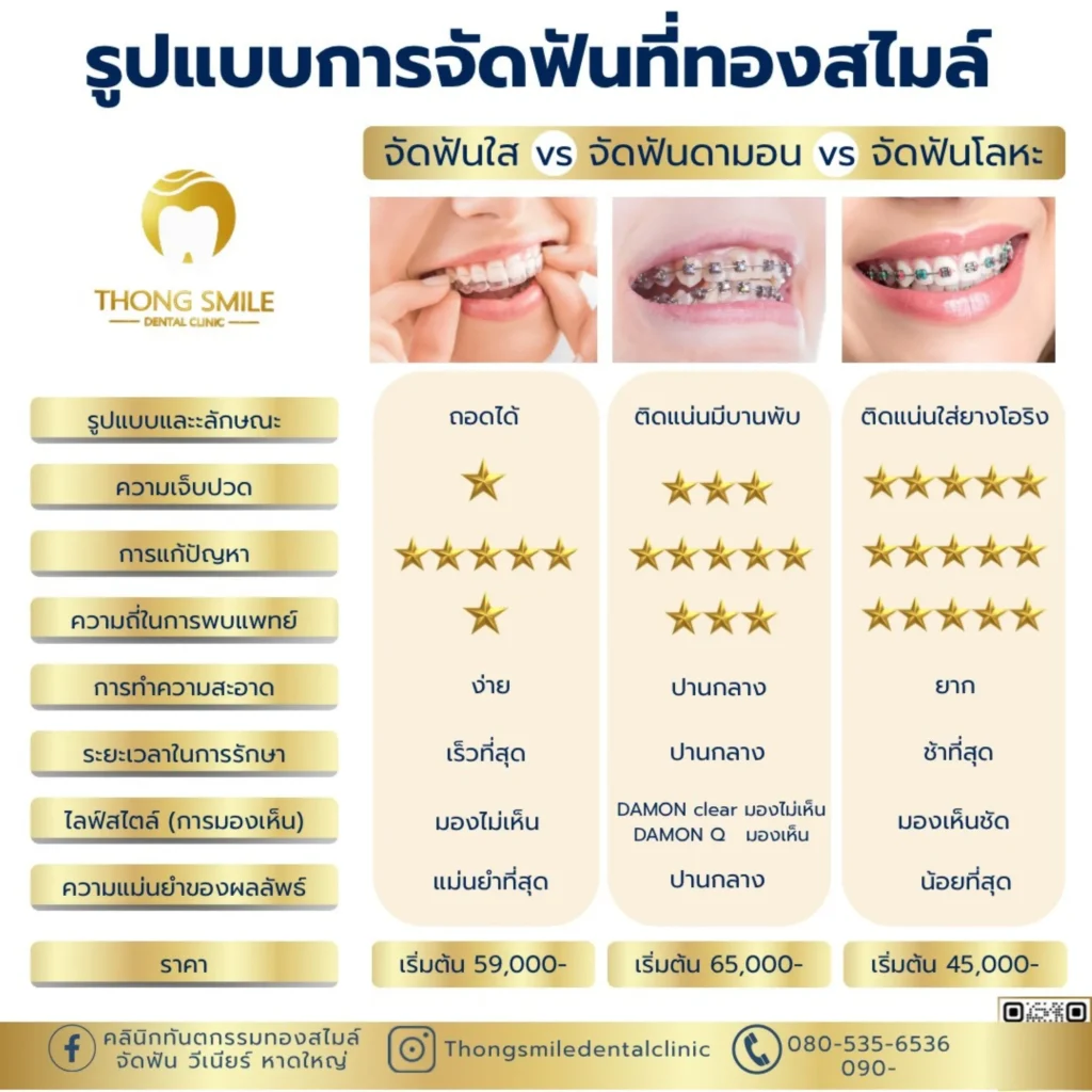 จัดฟันแบบไหนดี? เปรียบเทียบแต่ละแบบเลือกให้เหมาะกับคุณ 4 จัดฟันแบบไหนดี? เปรียบเทียบแต่ละแบบเลือกให้เหมาะกับคุณ