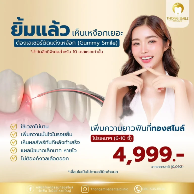 เลเซอร์ตัดเหงือก 1 20260508 Thong Smile 2 260508 4 Horizontal