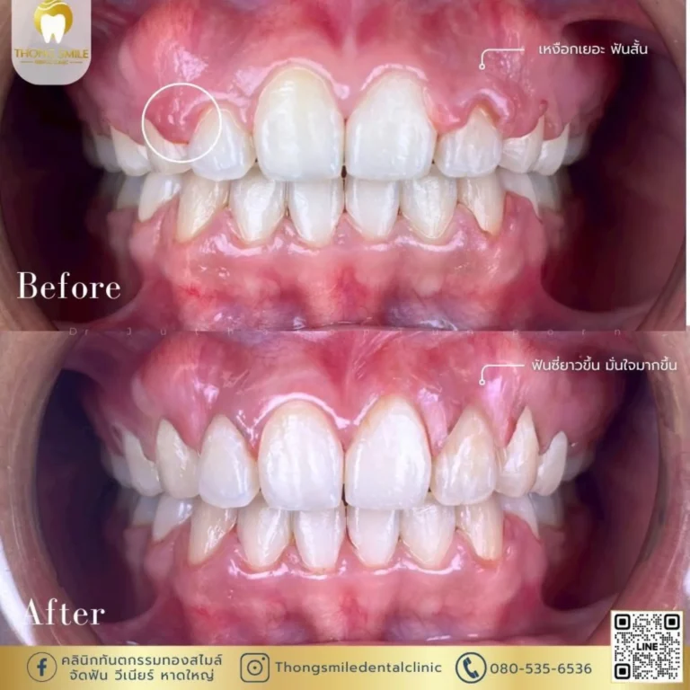 20260510 gum-laser-treatment-1 (Horizontal)