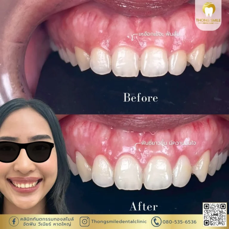 20260510 gum-laser-treatment-2 (Horizontal)