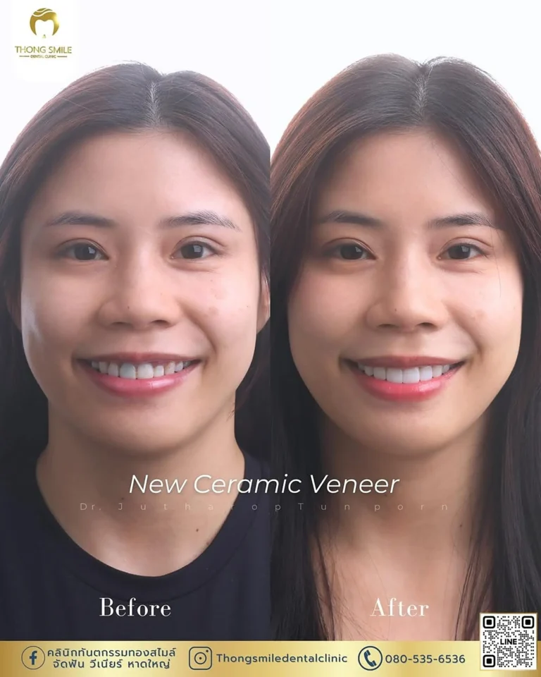 Ceramic Veneer Patient Reviews 260929 13