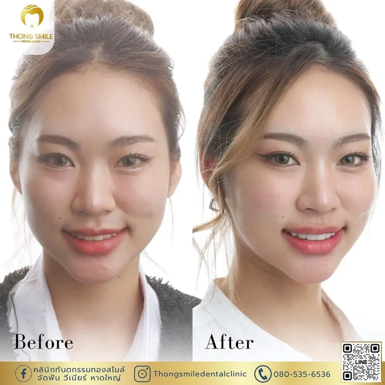 Ceramic Veneer Patient Reviews 260929 14