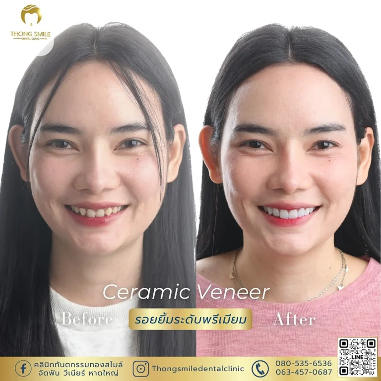 Ceramic Veneer Patient Reviews 260929 8